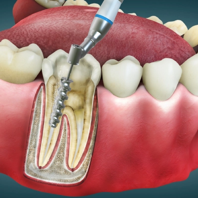 Common Symptoms of a Failed Root Canal