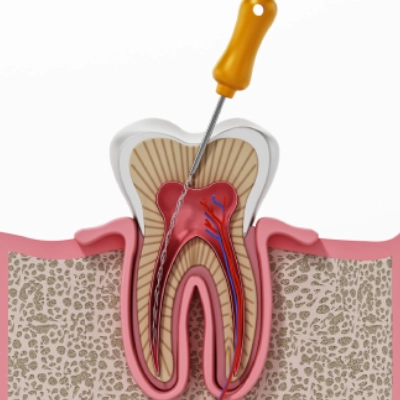 How to Treat a Failed Root Canal