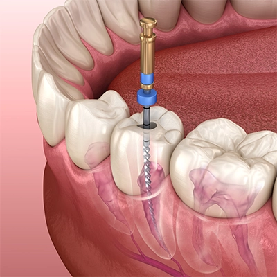How Long Does Root Canal Recovery Take?