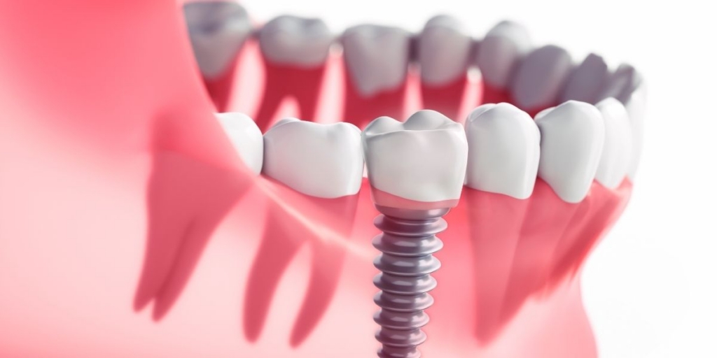 Dental implants in Chevy Chase MD at Chevy Chase Dental Care